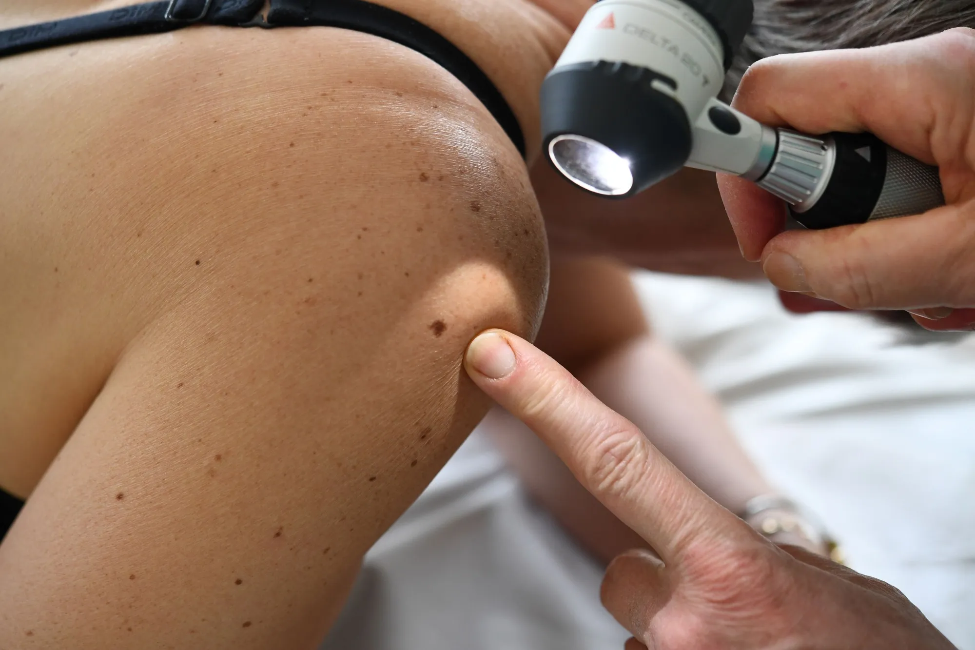 A dermatologist checks moles on a patient.