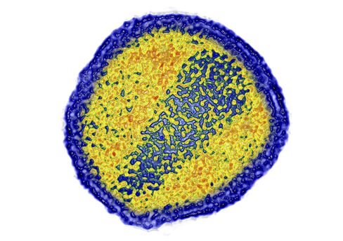 The HIV virus seen under a transmission electron microscope. Source: BSIP/UIG Via Getty Images