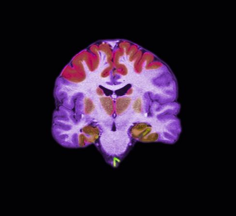 MRI Image of Alzheimer's Brain