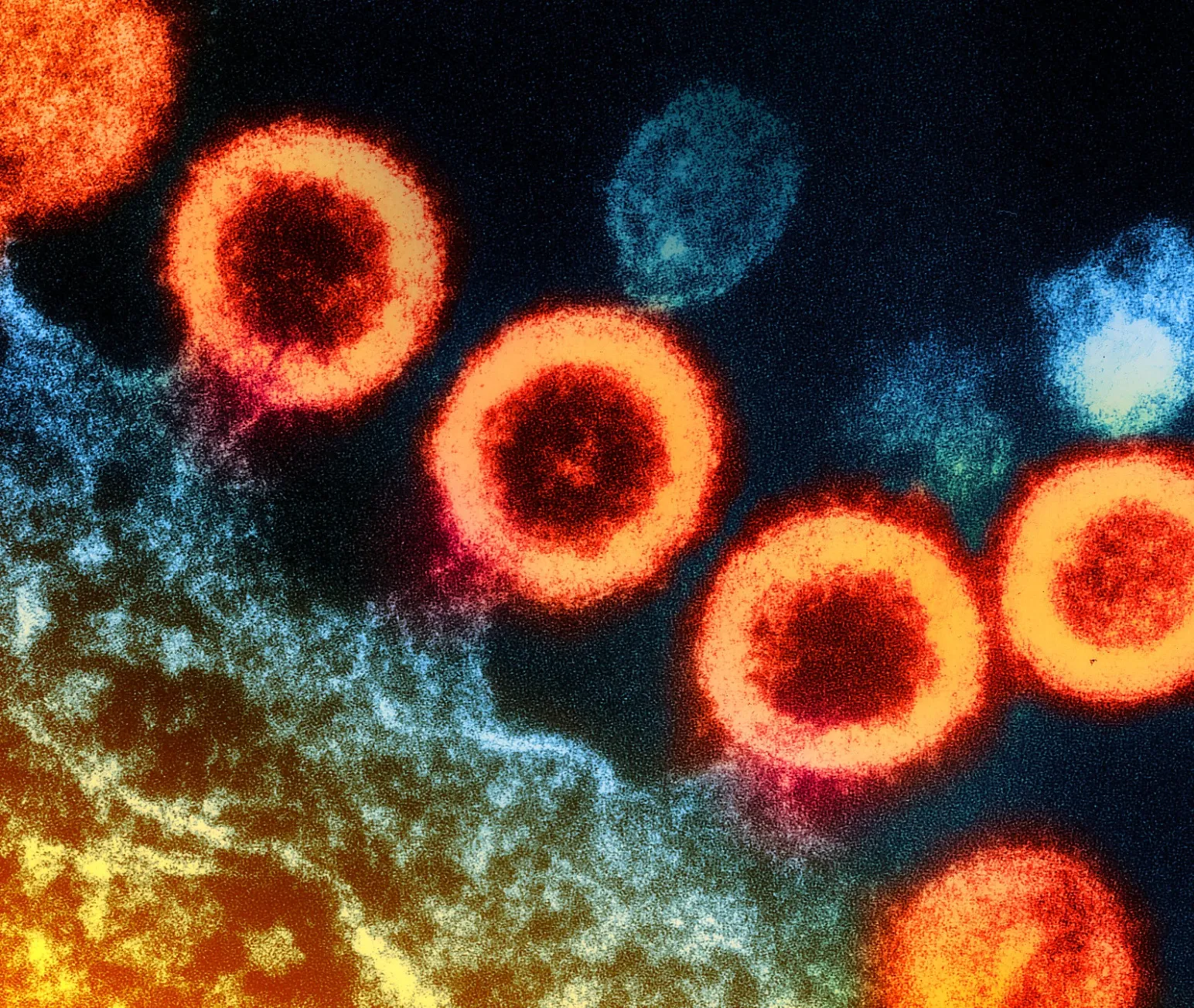 Transmission electron micrograph of HIV-1 virus particles.