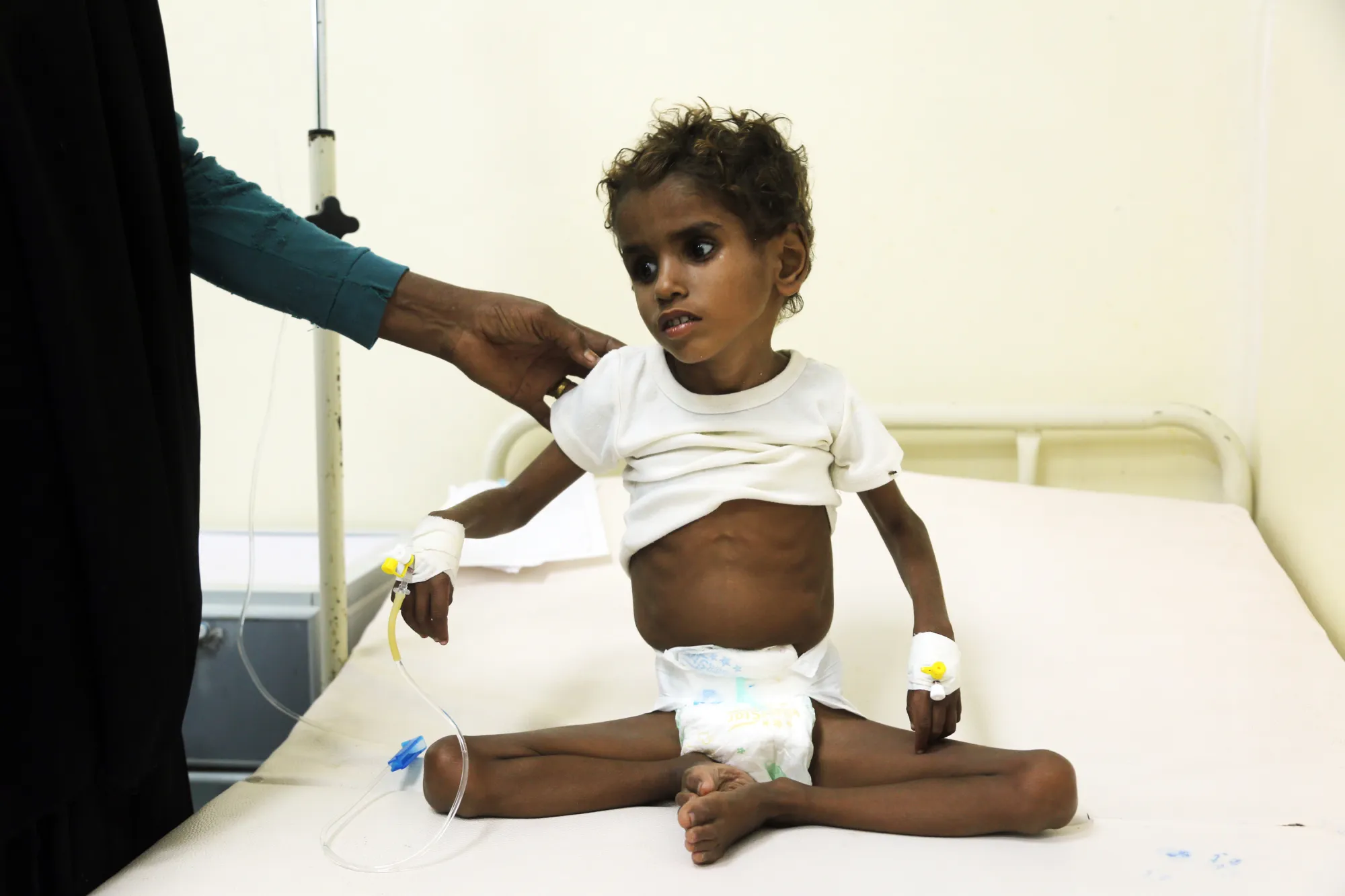 A malnourished Yemeni child receives treatment at a hospital in the Yemeni port city of Hodeidah on November 5, 2017.