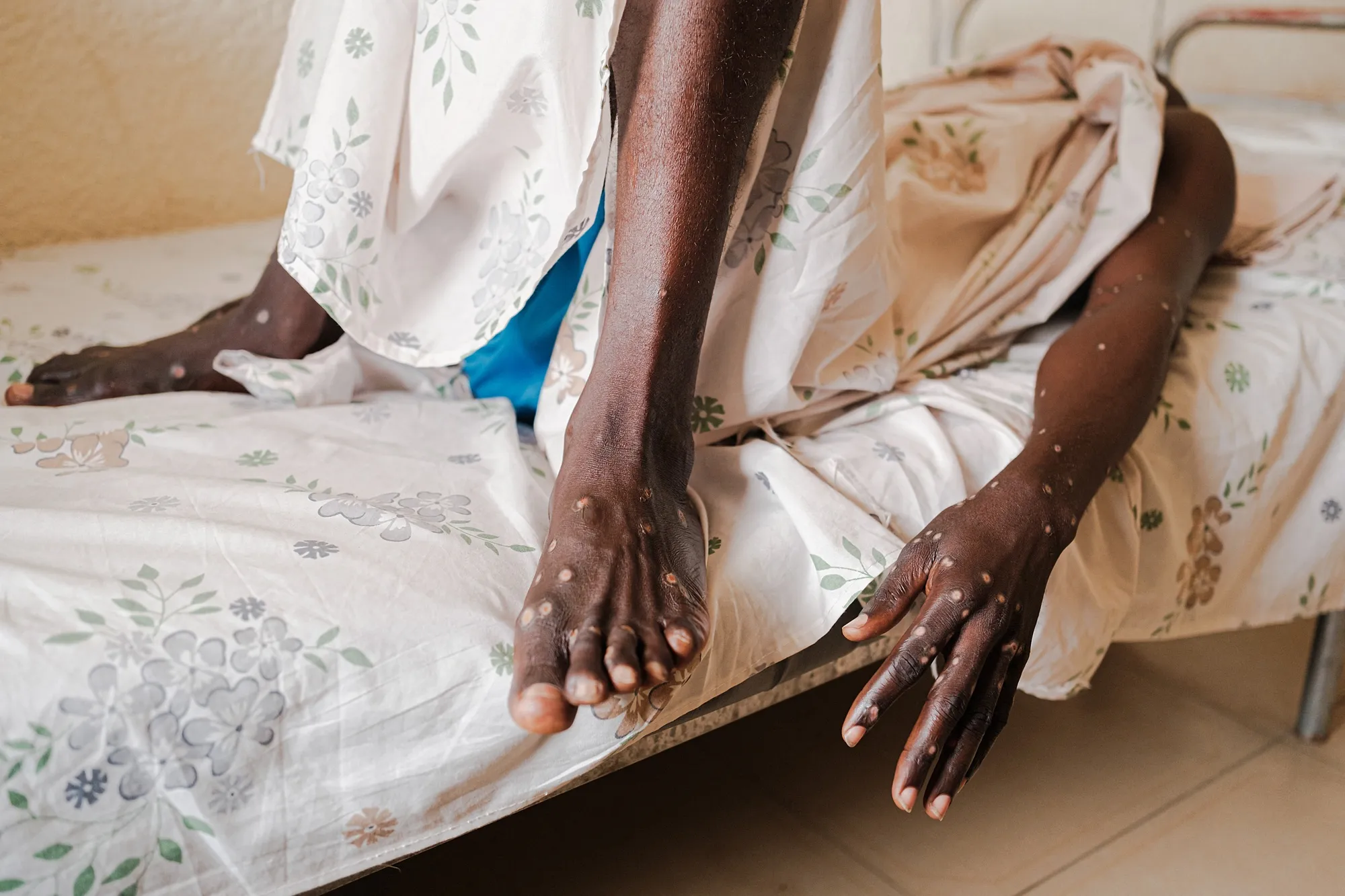 A man infected with Mpox lies on a bed at the Kamenge University Hospital's Mpox treatment center in Bujumbura, Burundi,&nbsp;on Aug.&nbsp;22.