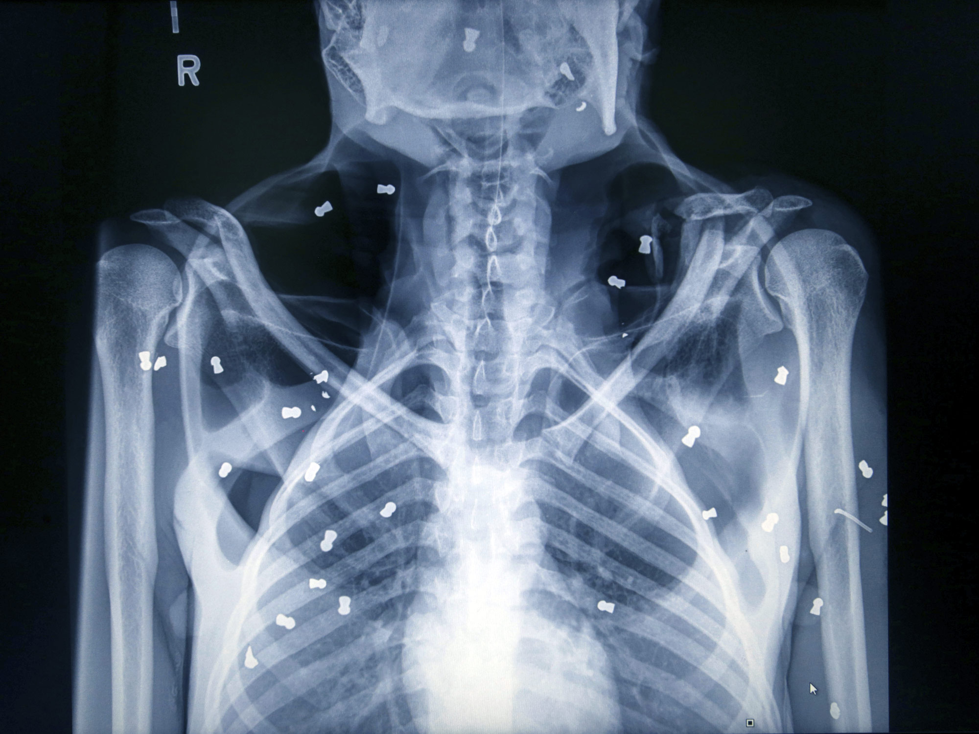 An X-ray showing air rifle pellets inside the body of female orangutan Hope.