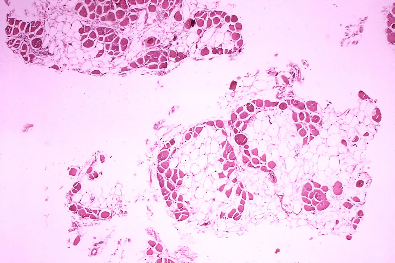 Histopathology of gastrocnemius muscle from patient who died of pseudohypertrophic muscular dystrophy, Duchenne type. Cross section of muscle shows extensive replacement of muscle fibers by adipose cells.
