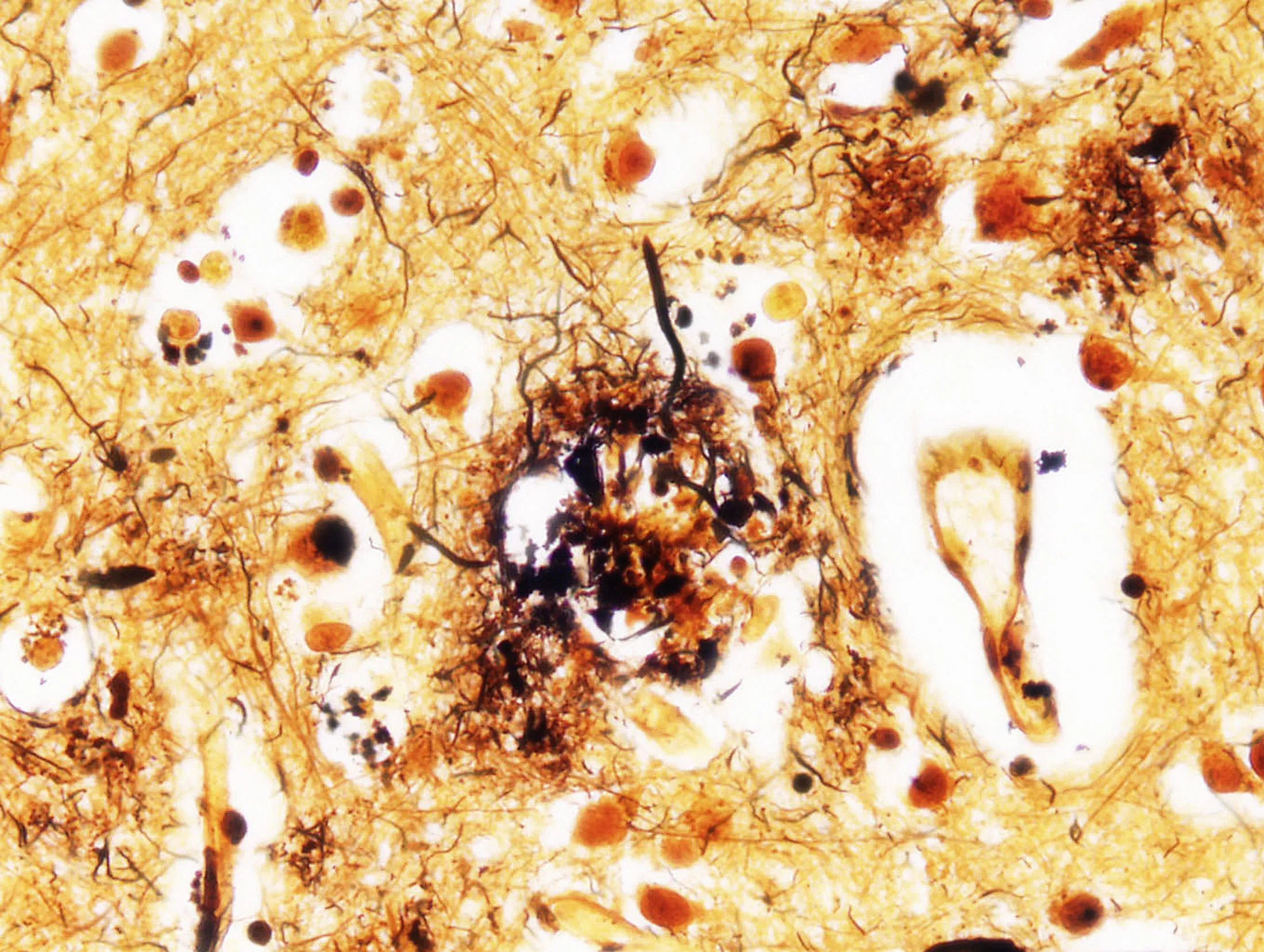 Amyloid and tau buildup.

