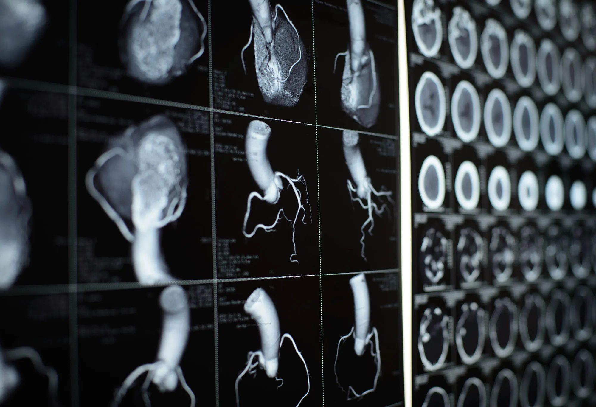 RF heart scan coronary artery medical healthcare