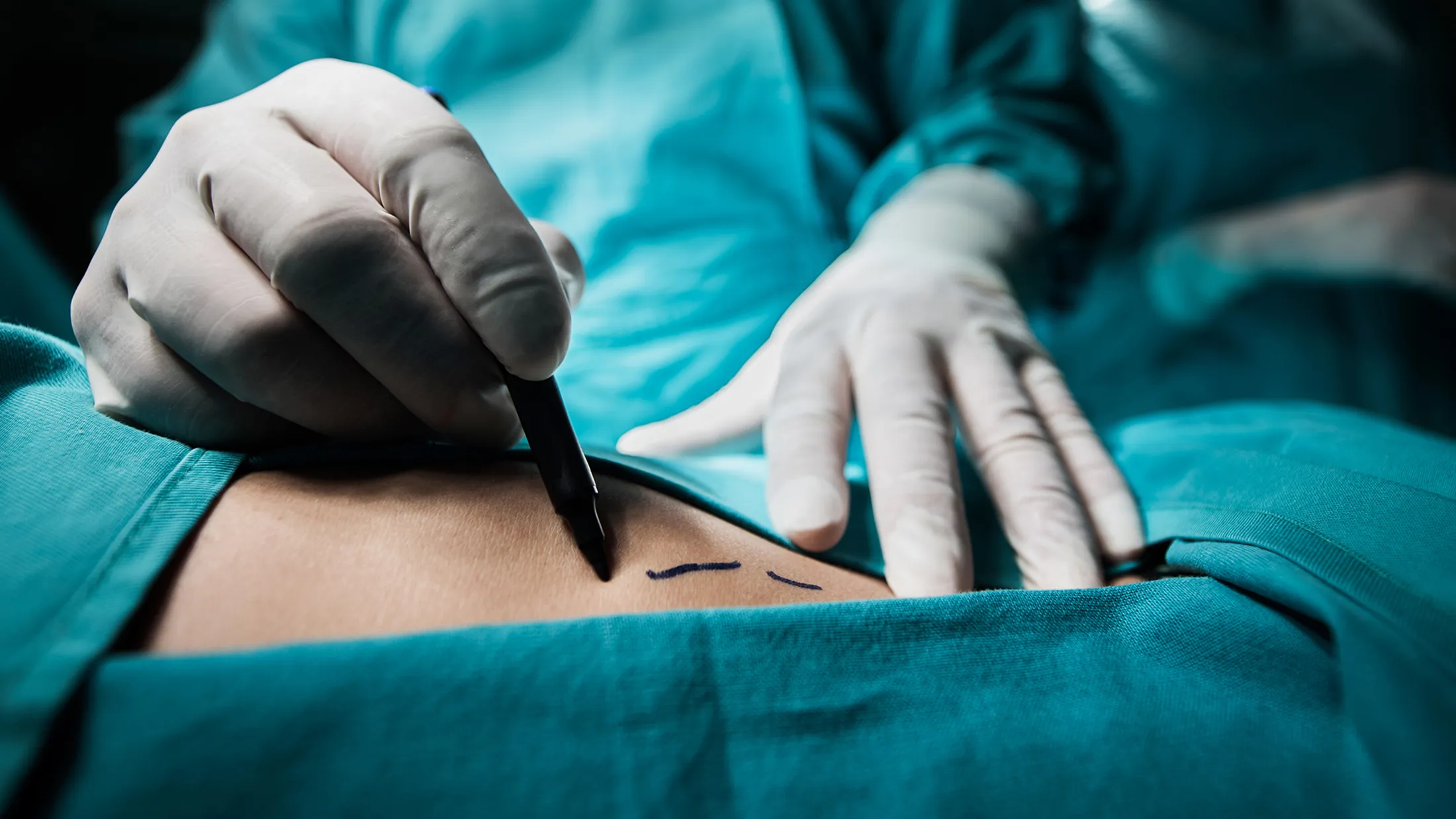 Close up of a plastic surgeon marking the human skin for surgery.