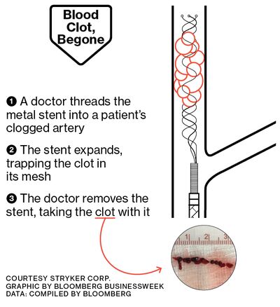 Blood clot graphic. Courtesy Stryker Corp.