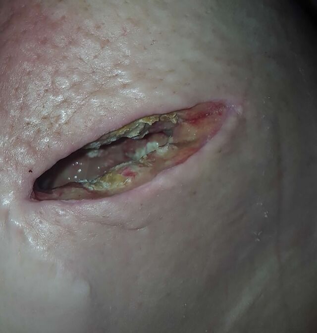 A photo of a BioZorb injury from a patient complaint.