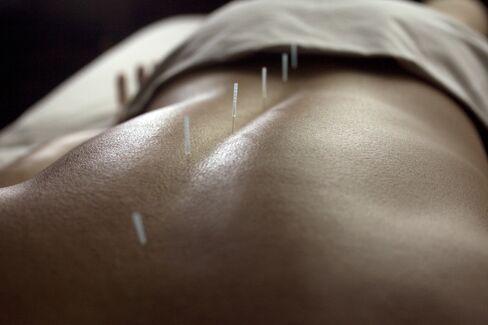 Acupuncture Relieves Pains, Study Finds