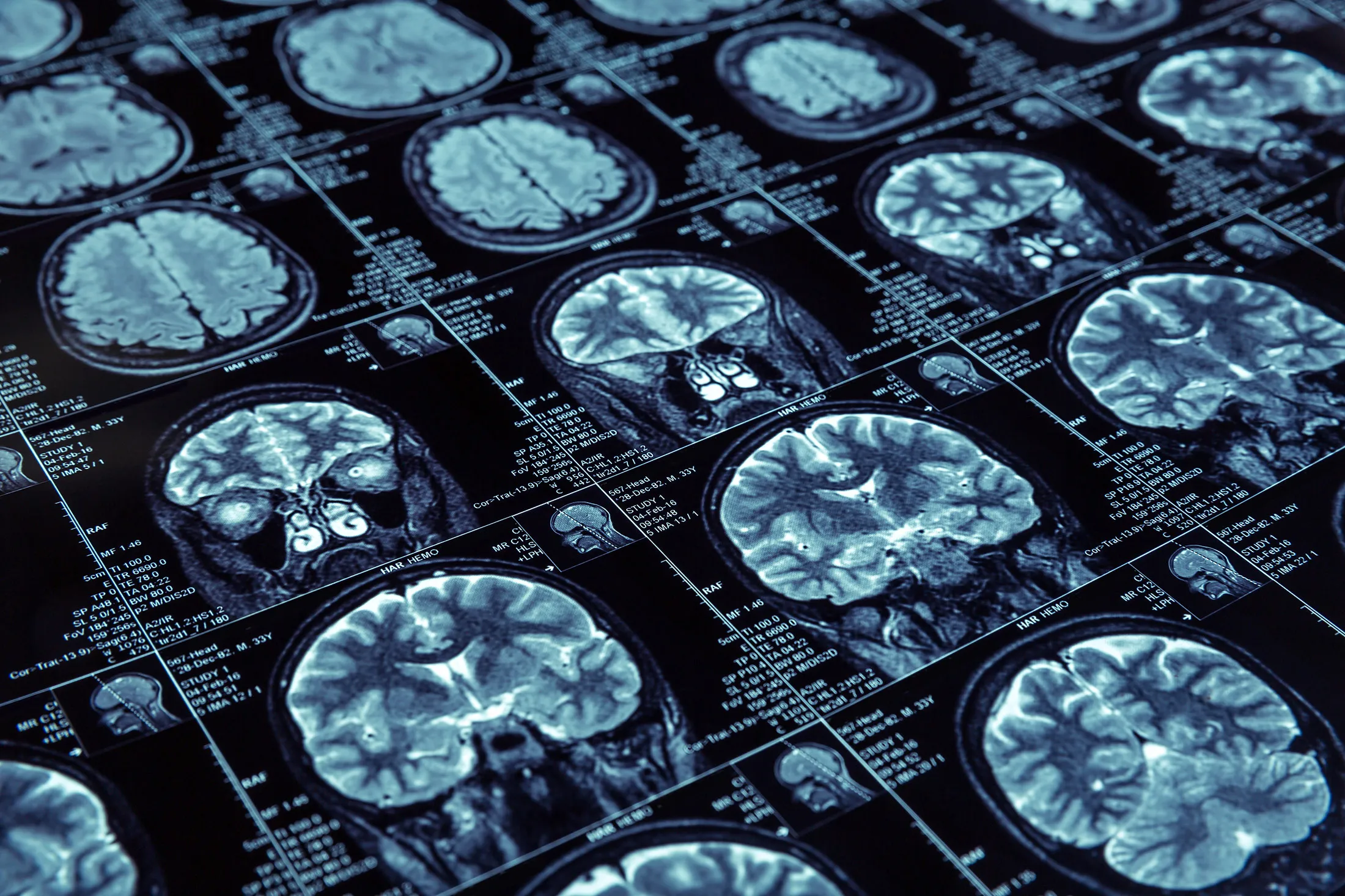 RF brain