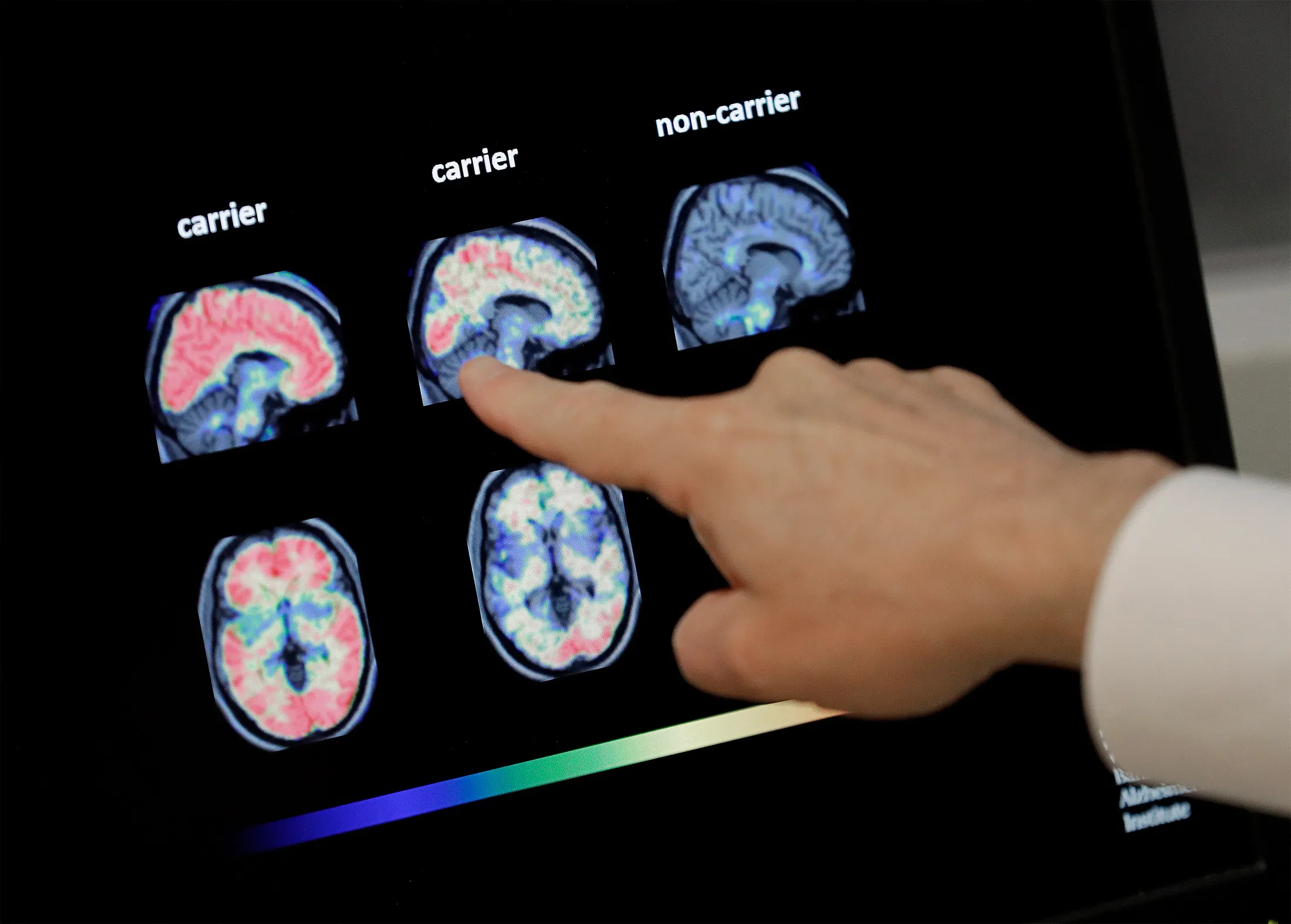 Aducanumab, delivered in monthly intravenous infusions, is thought to slow the progression of Alzheimer’s in people who show early signs of cognitive impairment.