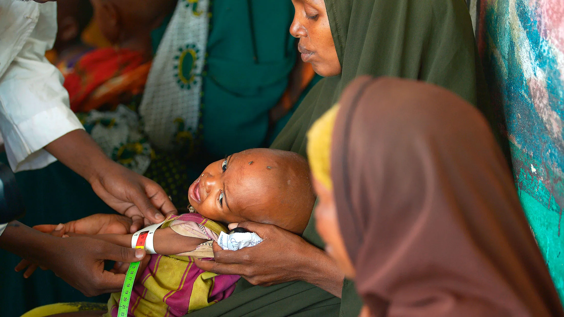 A malnourished child is processed by an aid worker for a UNICEF- funded health program in Baidoa town, the capital of the Bay region of south-western Somalia, on March 15, 2017.
