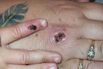 Monkey Pox Lesions
