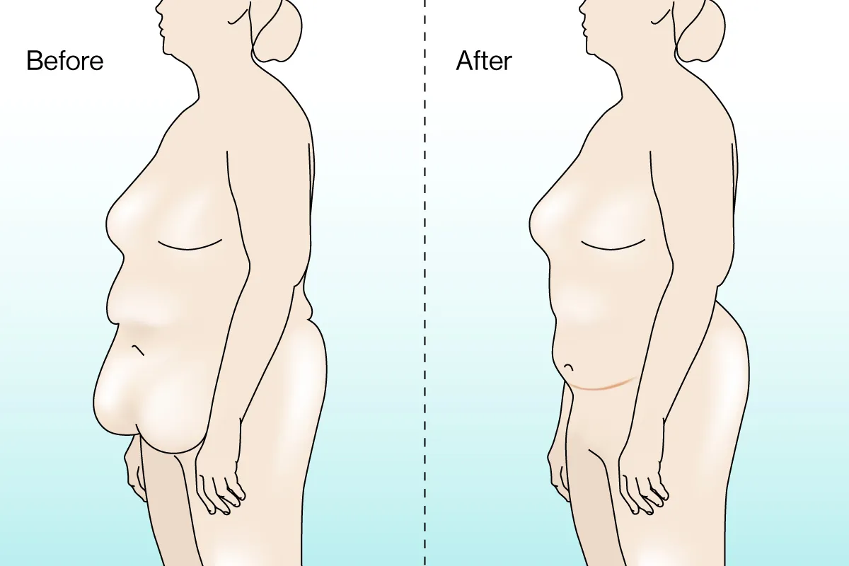 loose skin glp 1 Ozempic Weight Loss Leads to Plastic Surgery Boom to Shed Extra Skin