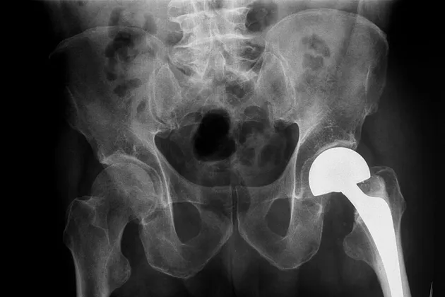 Hip prosthesis