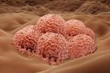 Melanoma, Skin cancer cells RF