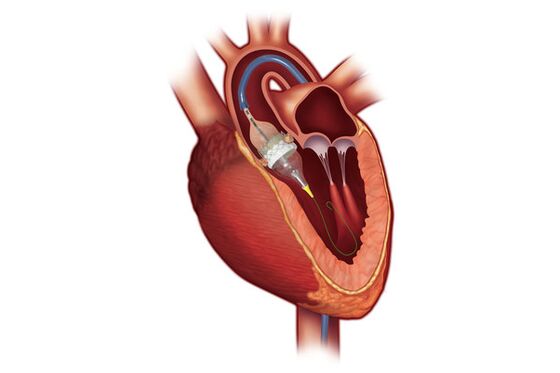 Heart Replacement Valves From Edwards and Medtronic Beat Surgery