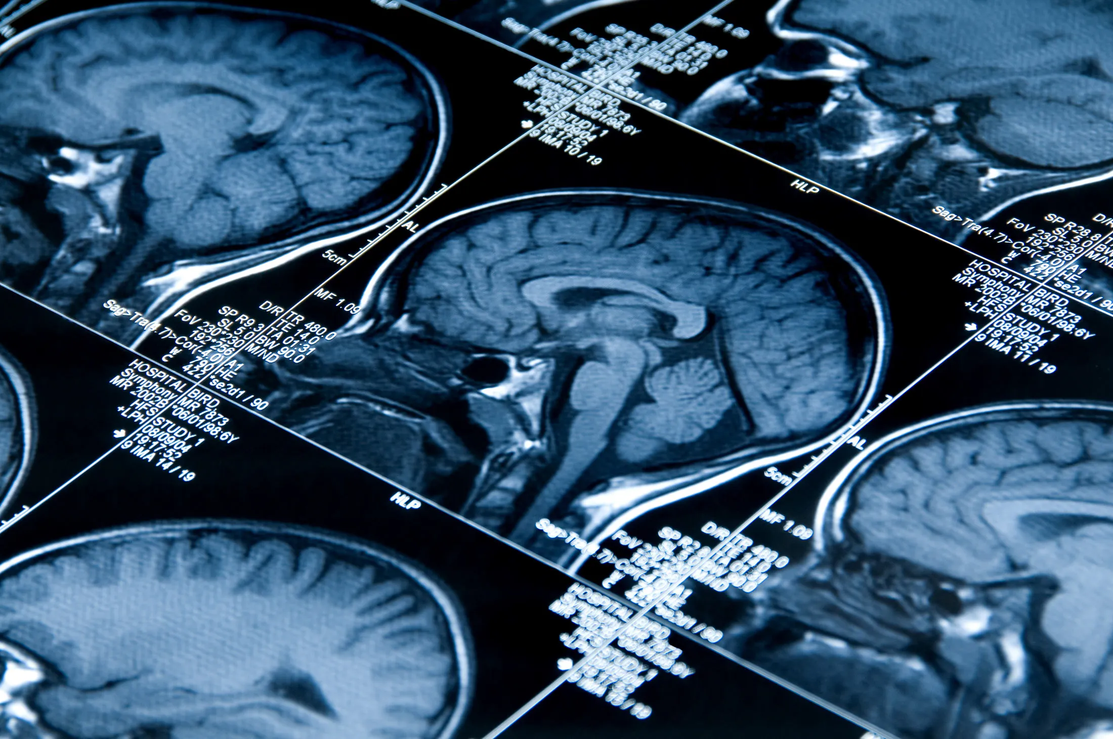MRI (Magnetic Resonance Image) Brain Scan