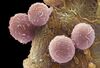 Leukaemia blood cells.