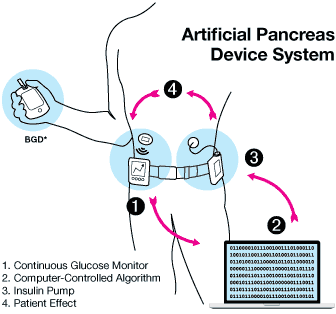 relaciona-se ao dano do paciente por fazer-você-mesmo pâncreas artificiais alerta o aviso do FDA