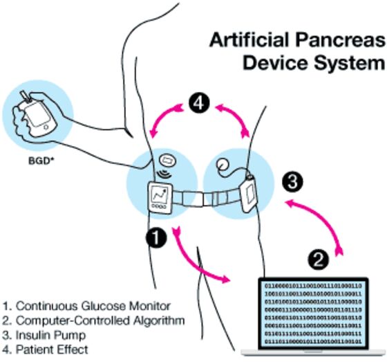 Patient Hurt by Do-It-Yourself Artificial Pancreas Prompts FDA Warning