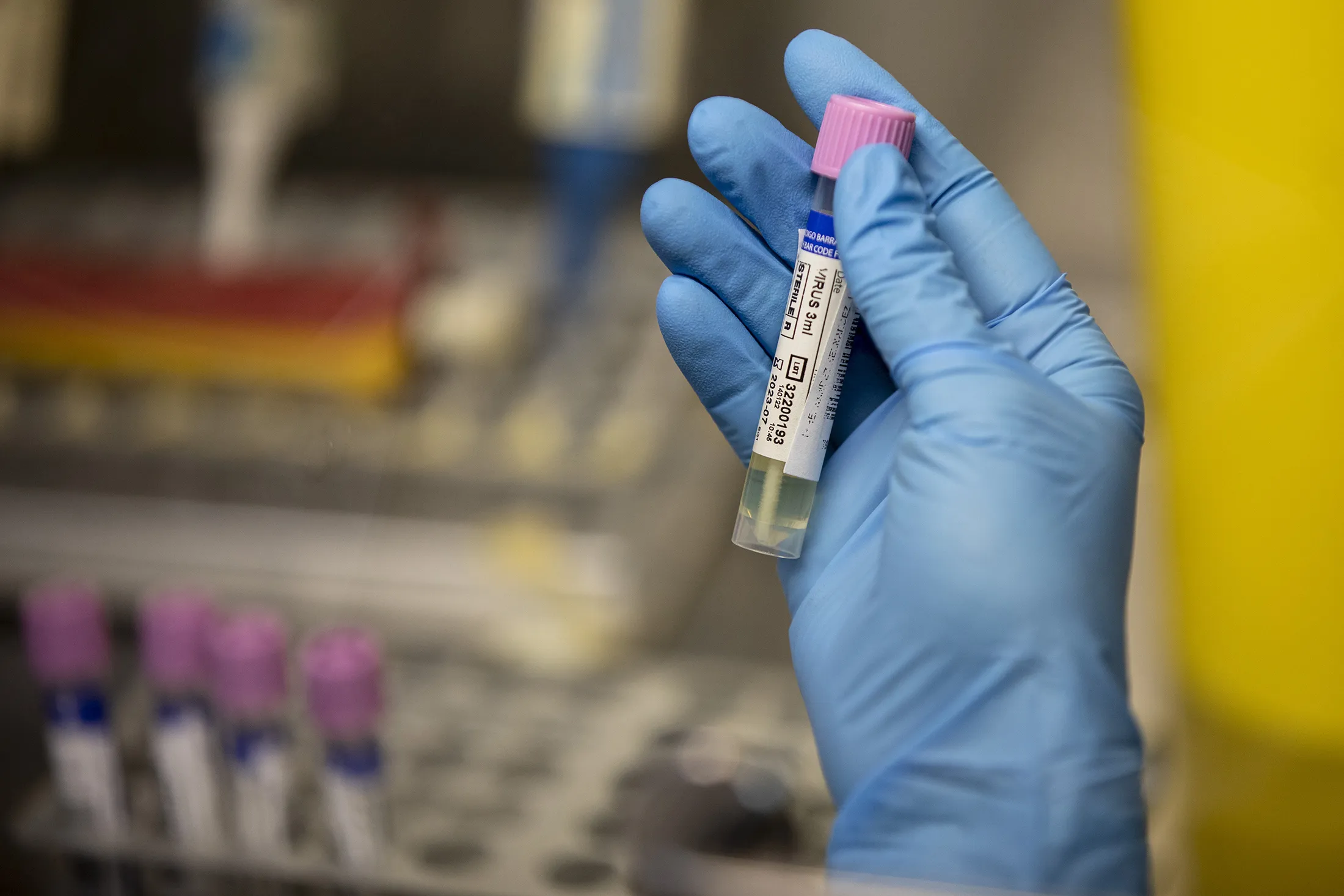 A medical laboratory technician displays&nbsp;a suspected monkeypox sample at a microbiology laboratory in Madrid, Spain, on June 6.