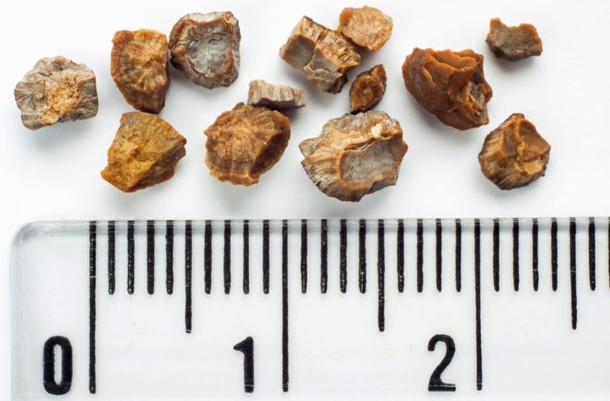 Камни в почках фото и описание Climate Change Could Cause More Kidney Stones - Bloomberg