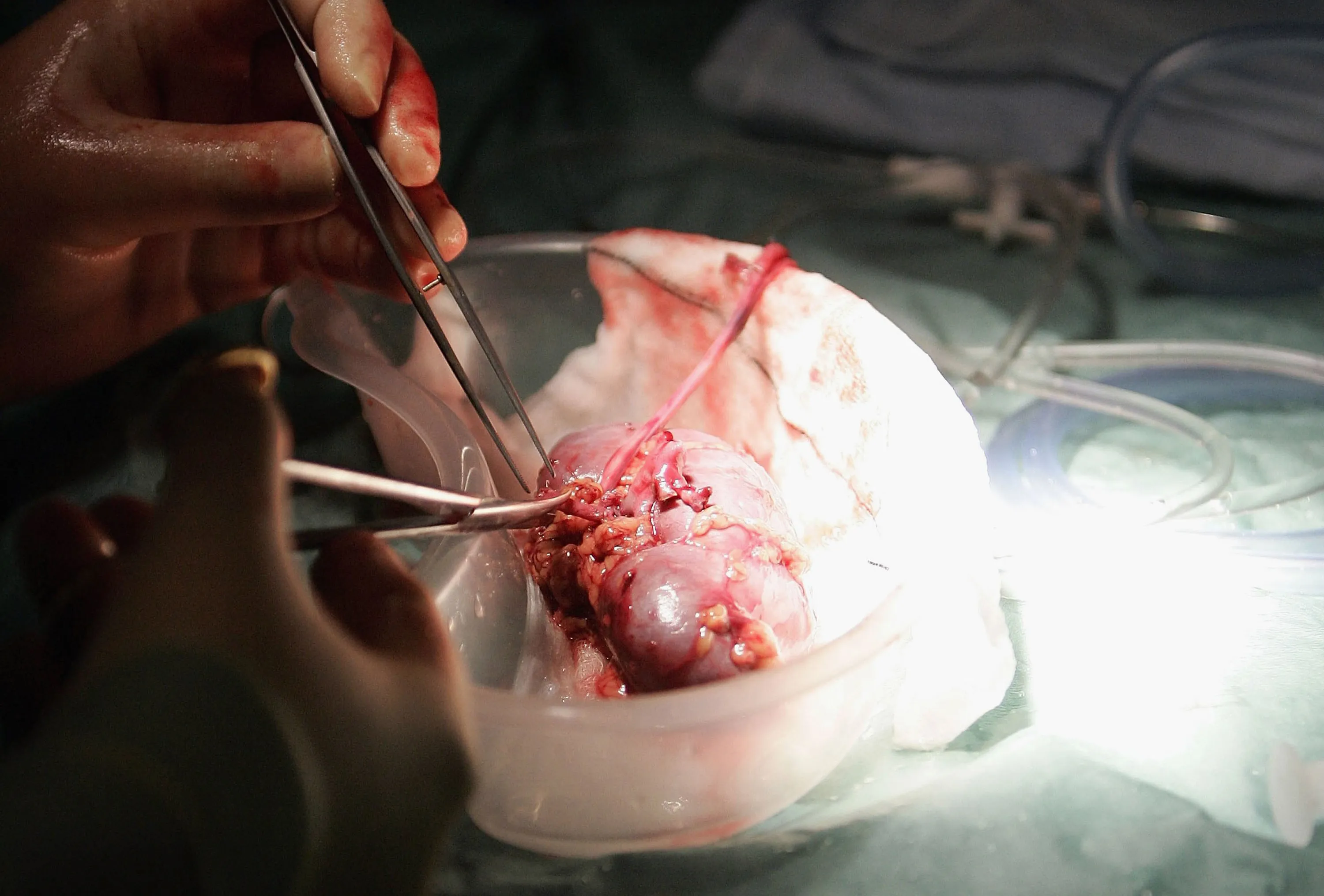 Kidney Transplant