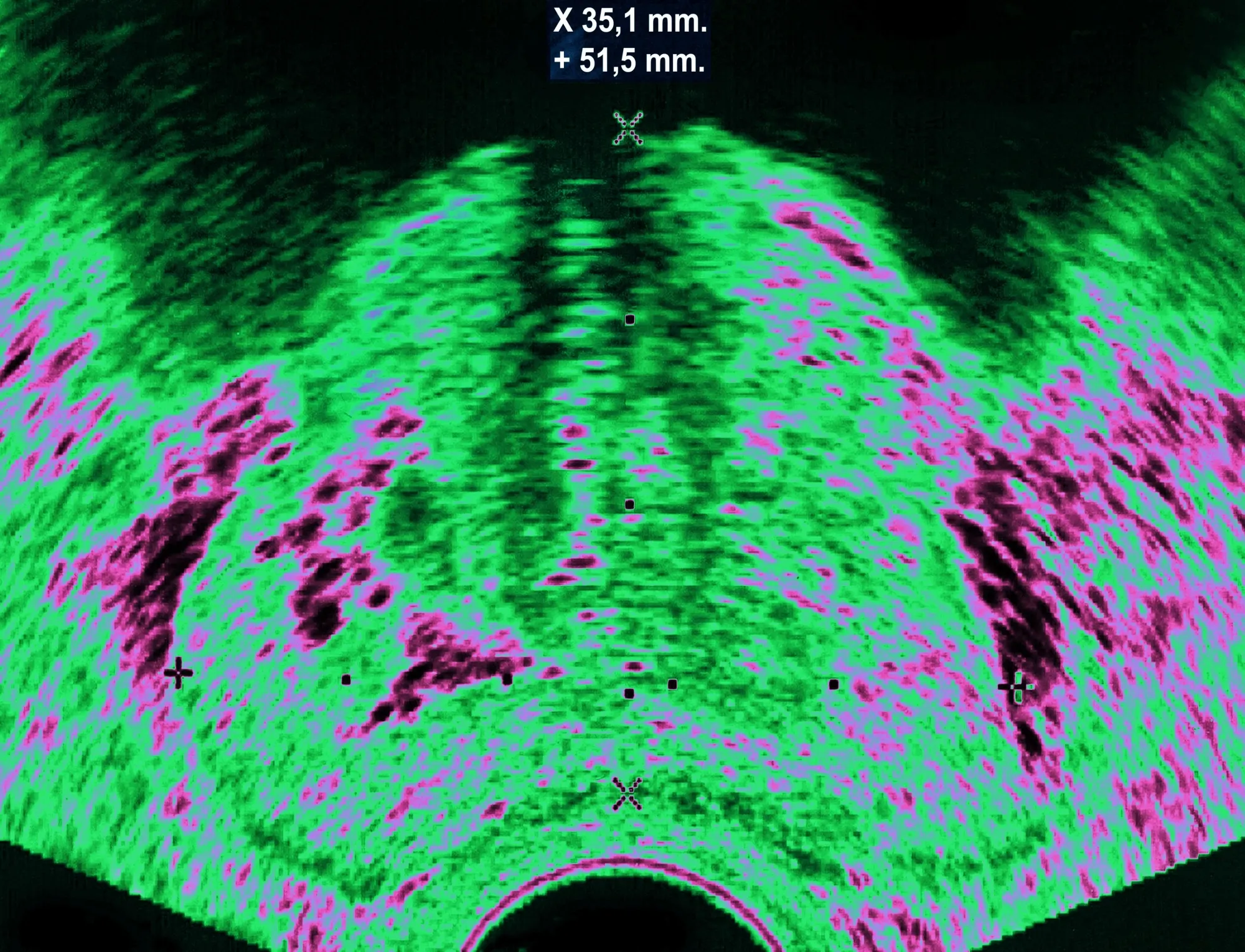 Prostate cancer visualized by ultrasound.