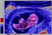 Ultrasound Biometry Of The Fetus