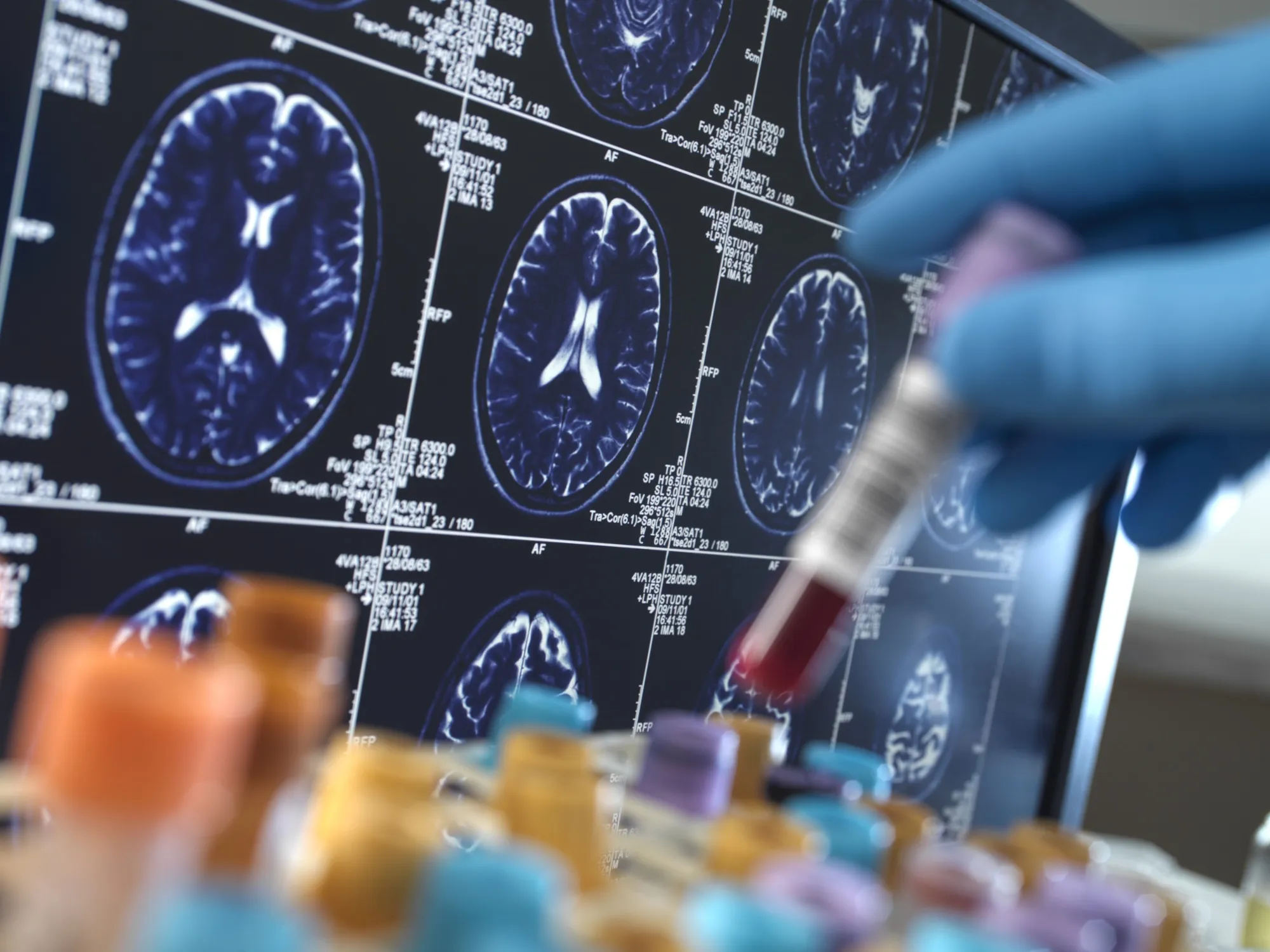 Scientists found there was a 35% reduced risk of dementia associated with&nbsp;sodium glucose cotransporter 2 inhibitors.