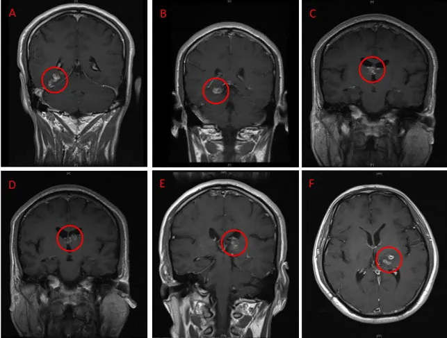 MRI brain scan over time. Source: Nagui Antoun