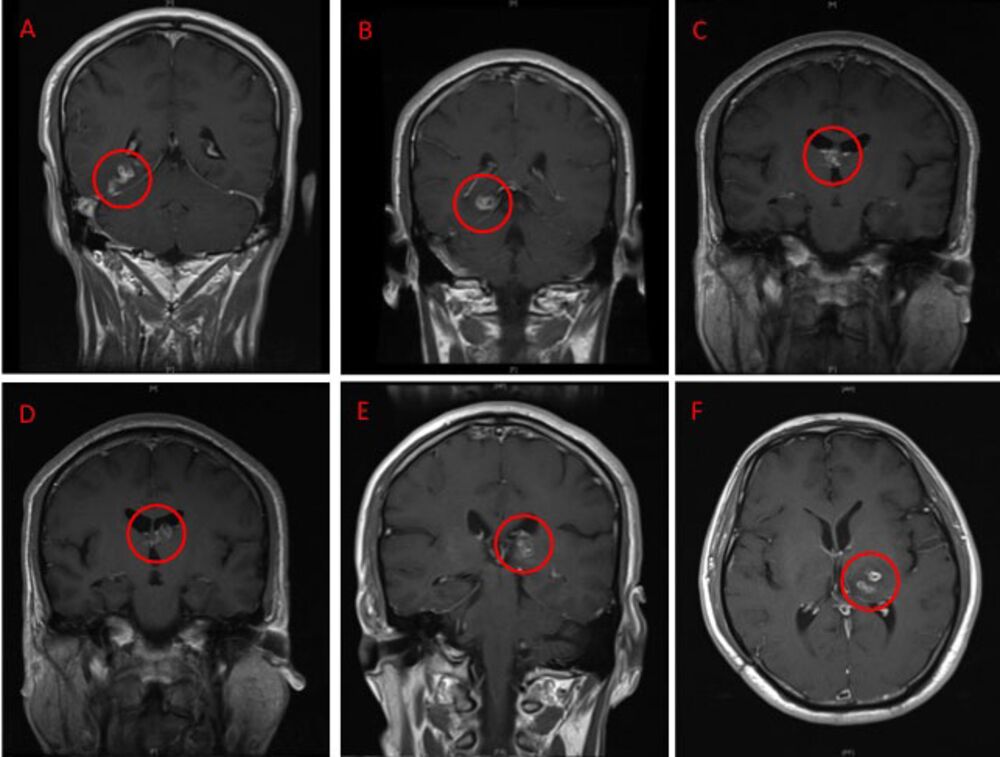 Everything You Never Wanted To Know About Brain Eating Worms Bloomberg