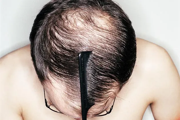 Turkey's Thriving Business in Hair, Beard, and Mustache Implants