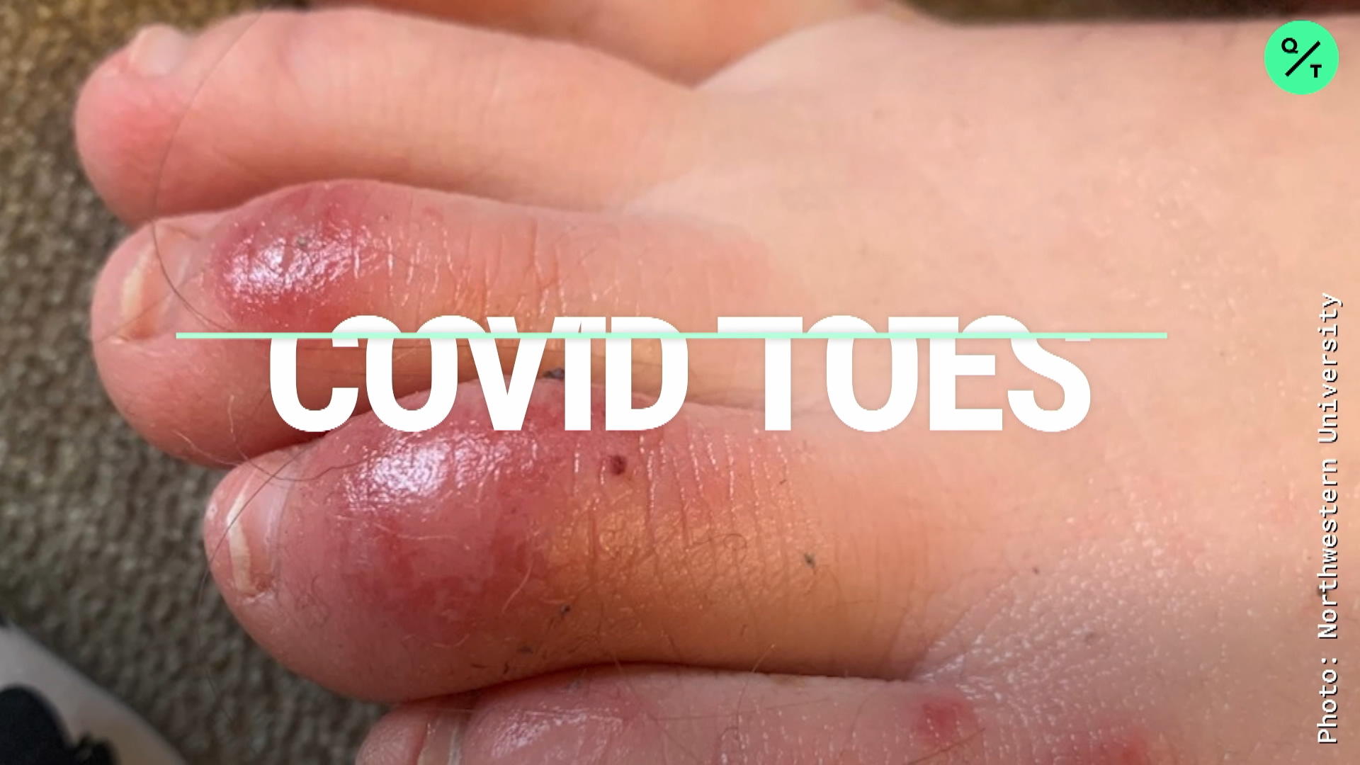 Watch Covid Toes A New Symptom Of Coronavirus Bloomberg