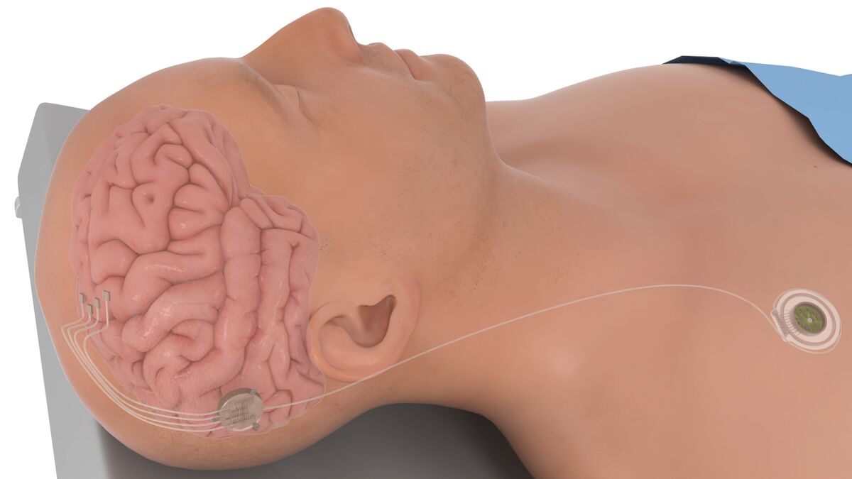 Neuralink Competitor Raises $20 Million for Brain Implants - Bloomberg