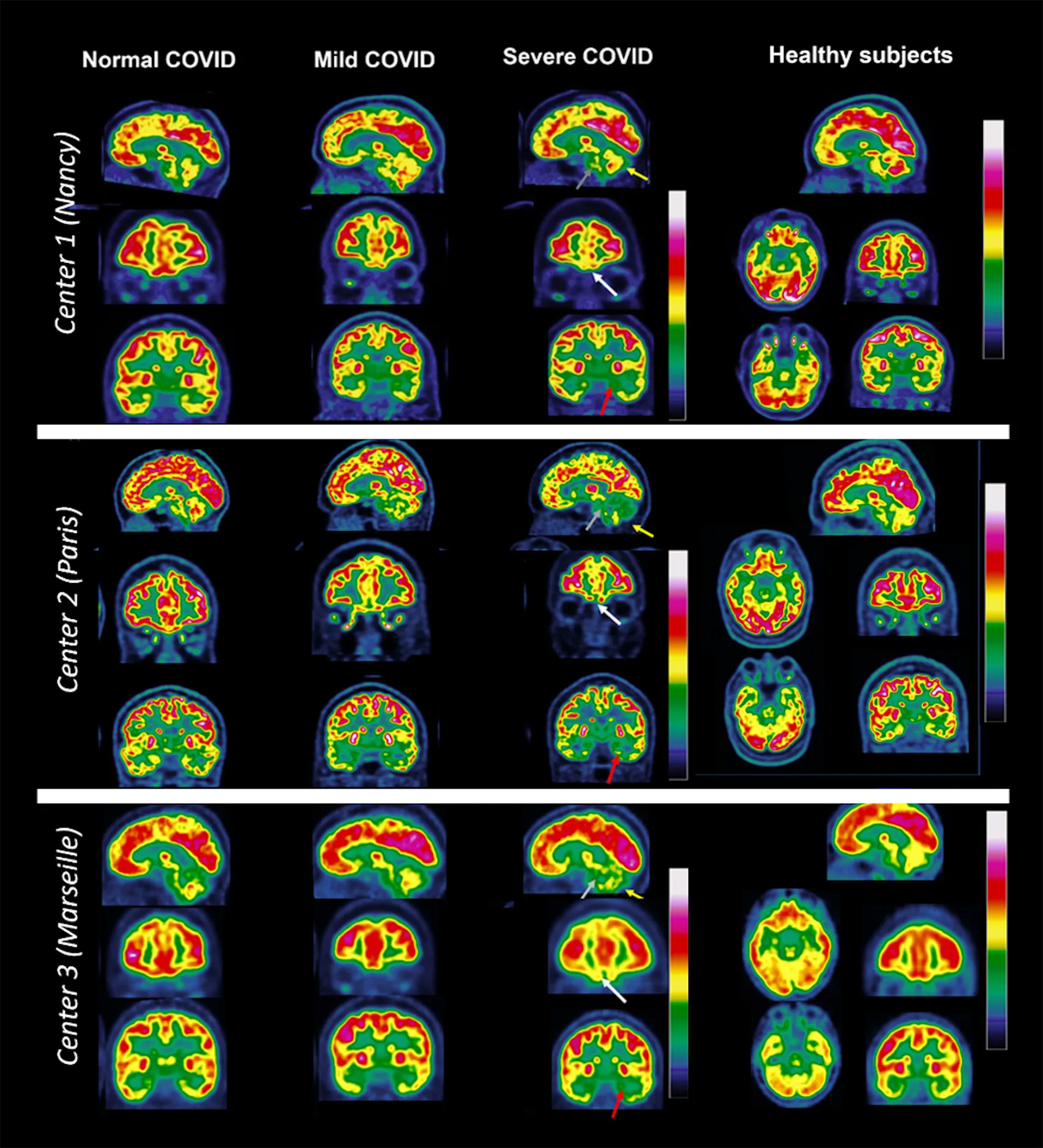 Brain PET images of patients with long Covid from three French nuclear medicine departments, CHRU of Nancy, Timone Hospital, APHM Marseille and Pitié-Salpêtrière Hospital, APHP, Paris.