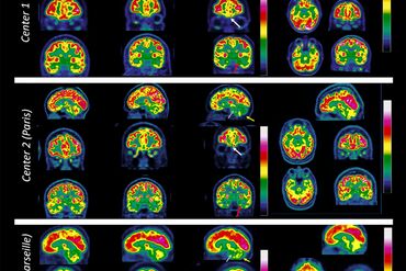 What We Know About Covid’s Impact on Your Brain