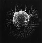 A breast cancer cell is seen photographed by a scanning electron microscope.