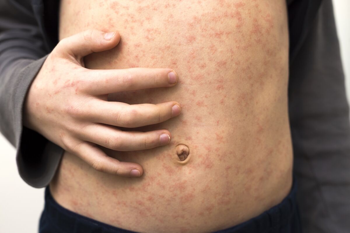 Measles Cases Are Surging. What Are We Doing About It?