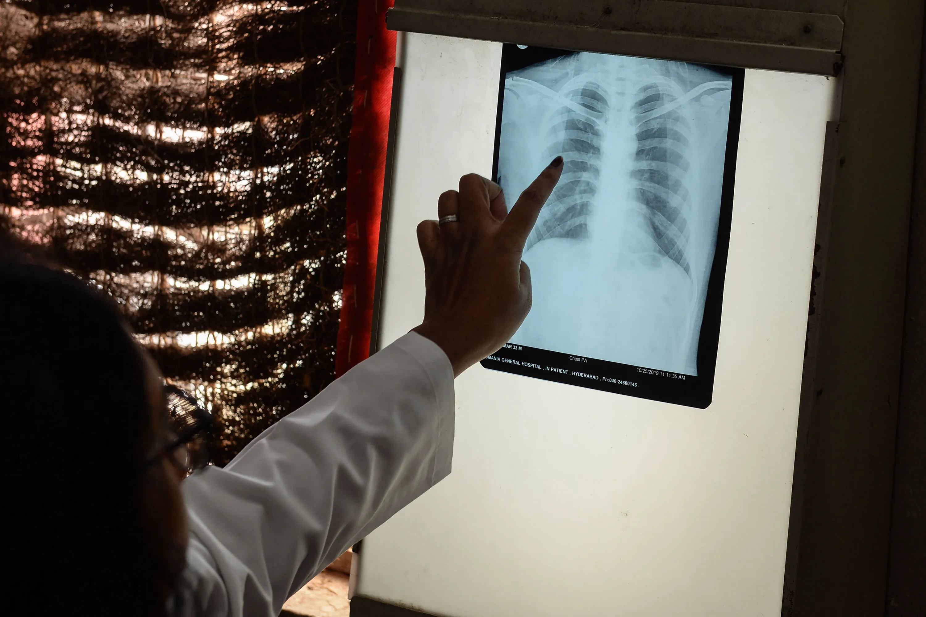 A doctor checks the chest X-ray of a patient in the tuberculosis department of a hospital in Hyderabad.
