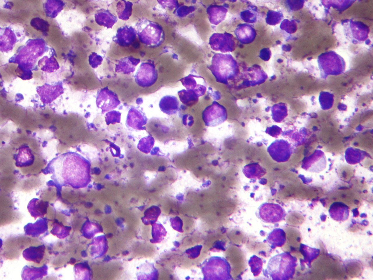 Micrograph of a large B-cell lymphoma.
