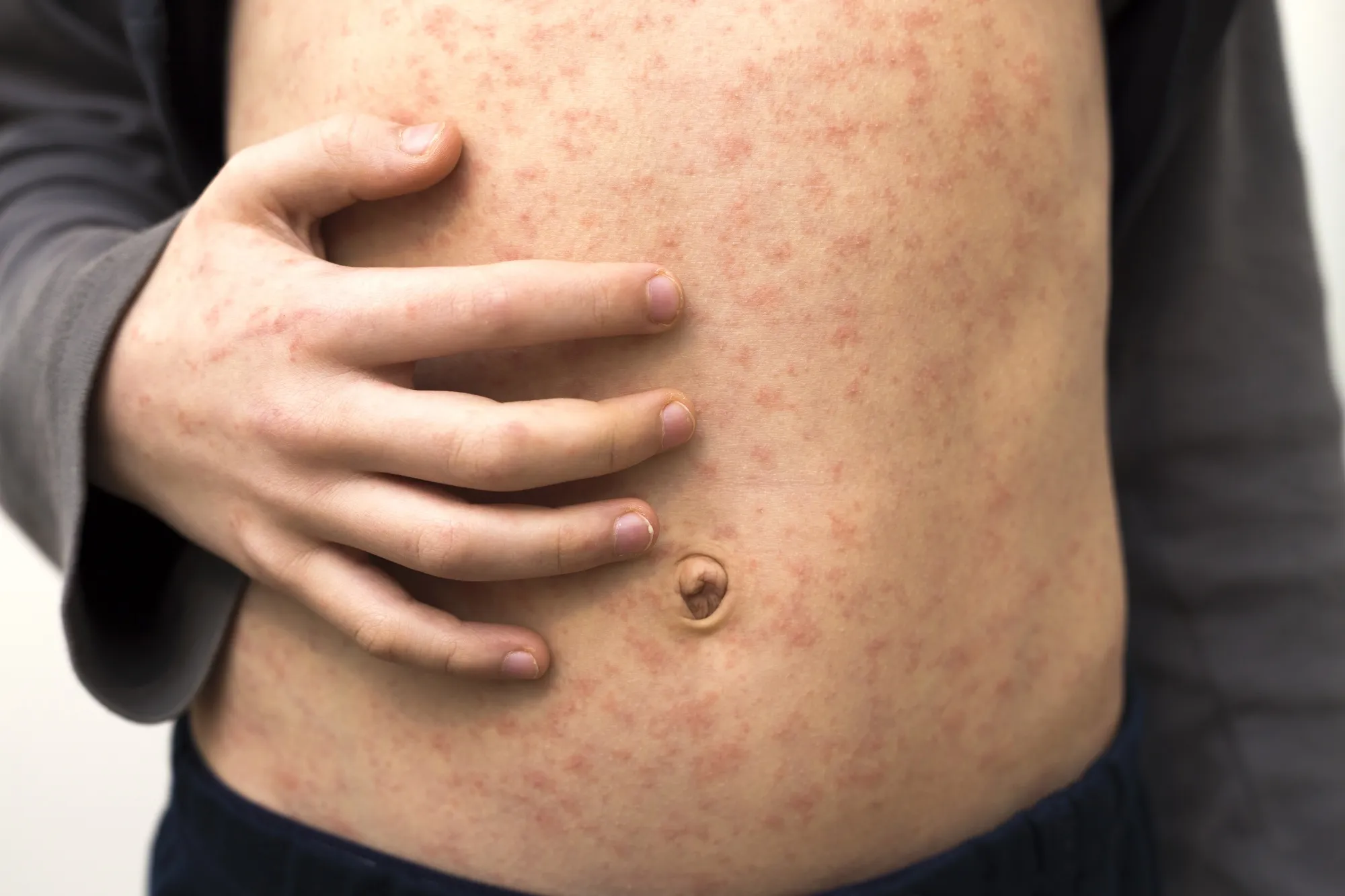 Sick child with rash spots from measles.