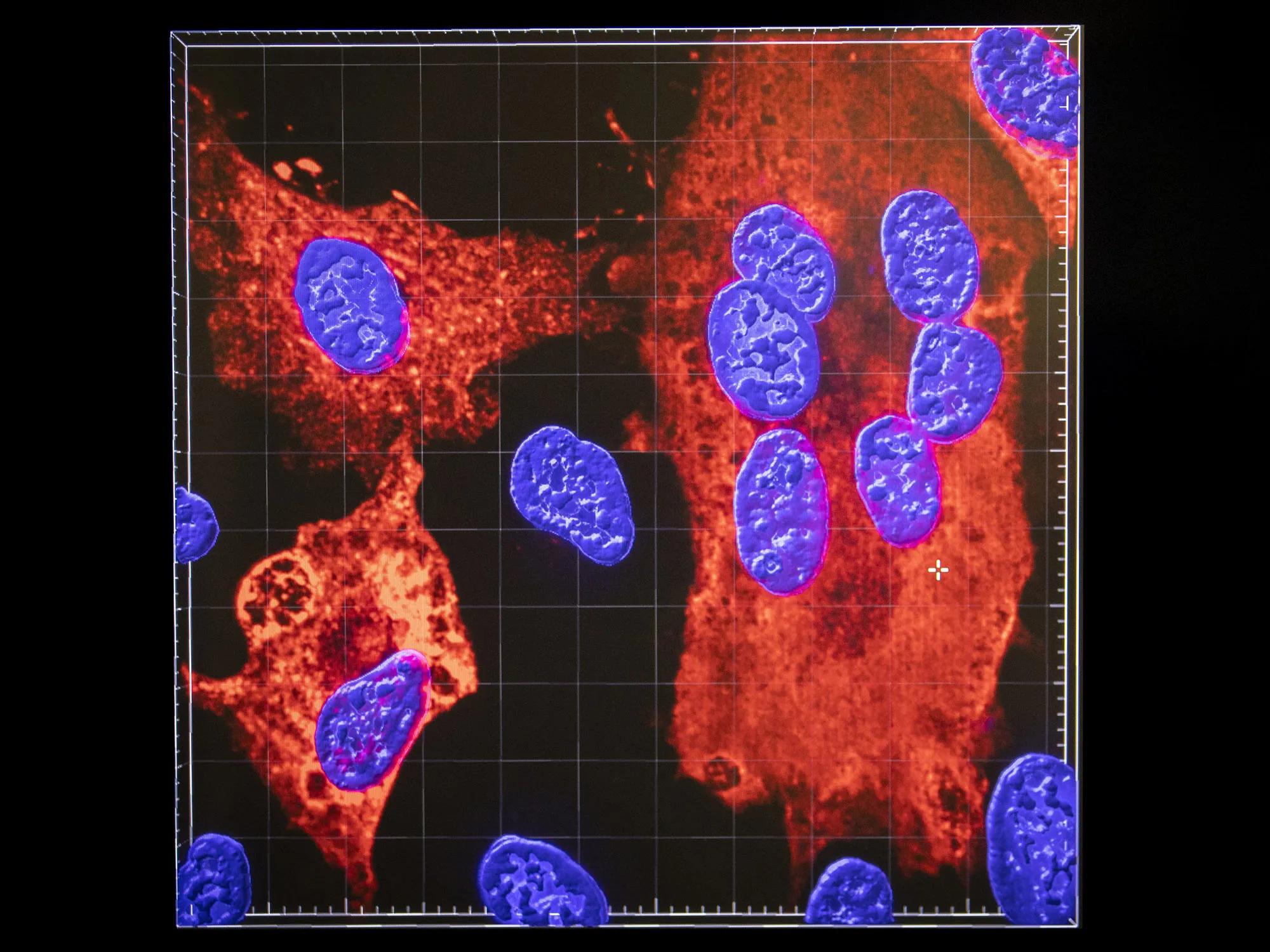Cell nuclei (blue) being infected by SARS-CoV-2 (red areas), the virus.