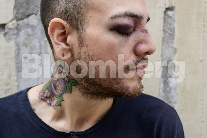 Dozens Blinded By Chile Police In Violent Crackdown On Protests