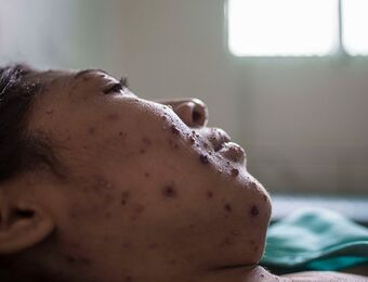 relates to Northeast Measles Outbreak Should Be a Vaccine Wake-Up Call