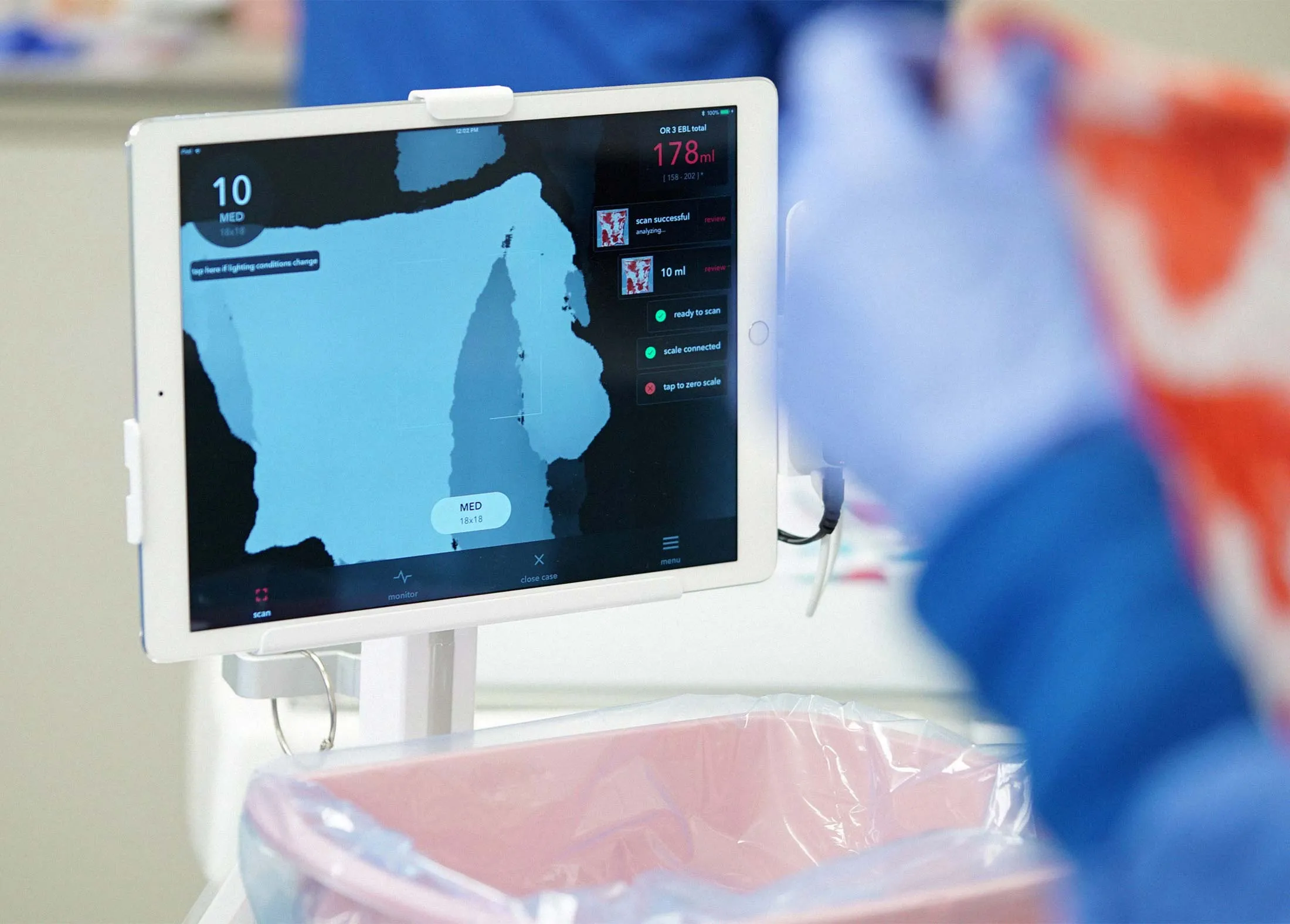 Blood loss is measured with the Triton blood loss monitor.