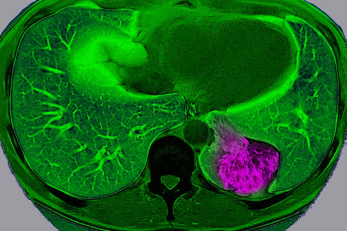 Cancer Drugmaker Parabilis Seeks $475 Million in US IPO