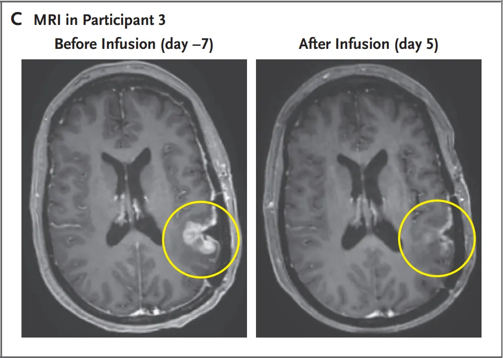 Brain Cancer Treatment: CAR-T Therapy Shown to Help Shrink Tumors ...